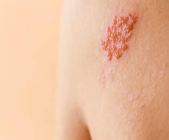 Shingles-symptoms-on-back